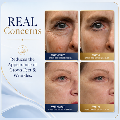 AUROLYSE™ Under Eye Bag & Wrinkle Treatment